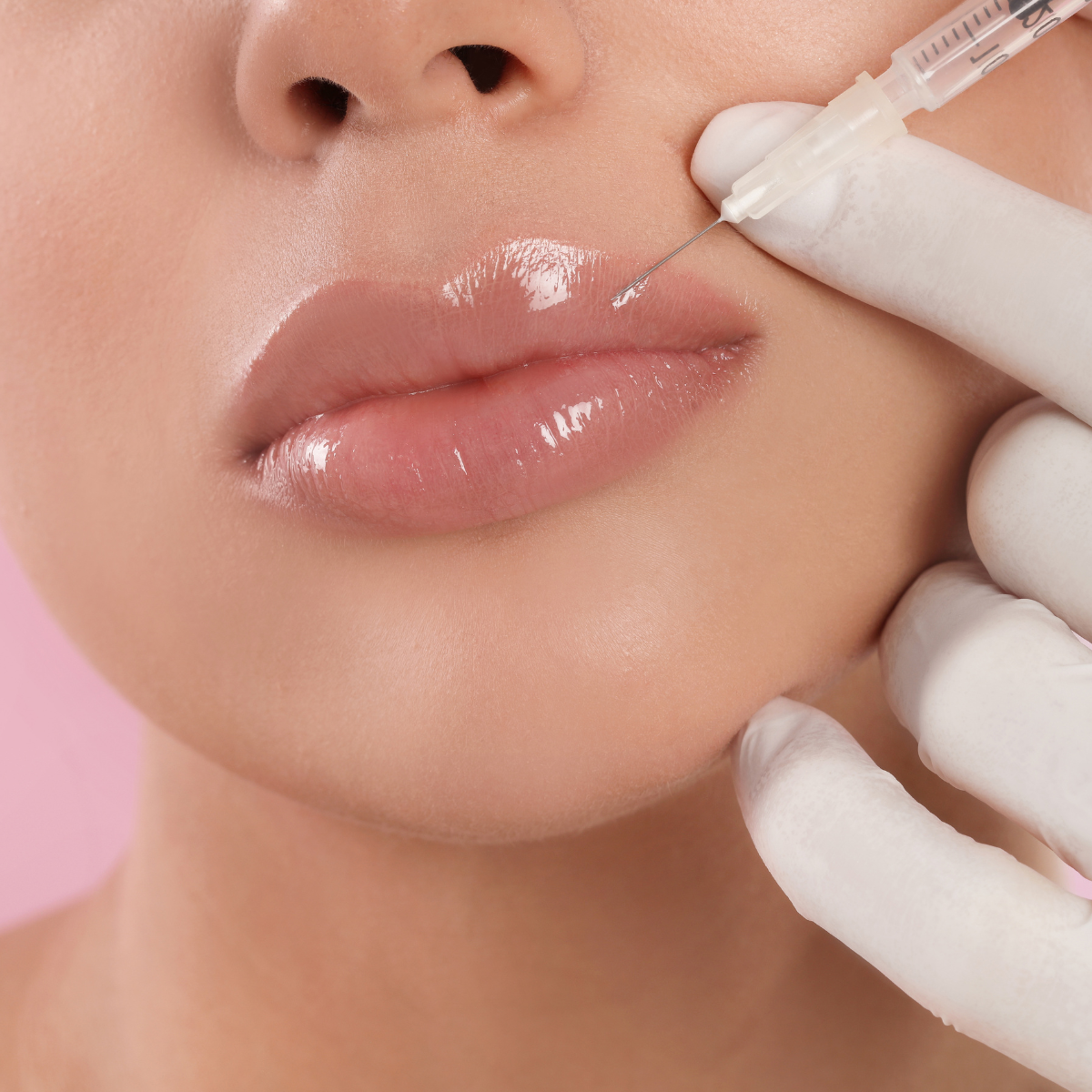 Why Should You Get Lip Filler?